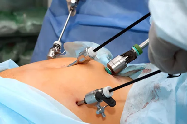 Advanced Laparoscopic Surgery